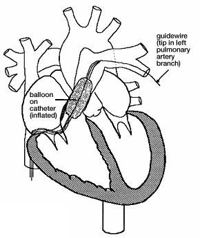 Clinical Therapy Dilation by balloon valvuloplasty, performed during cardiac catheterization.