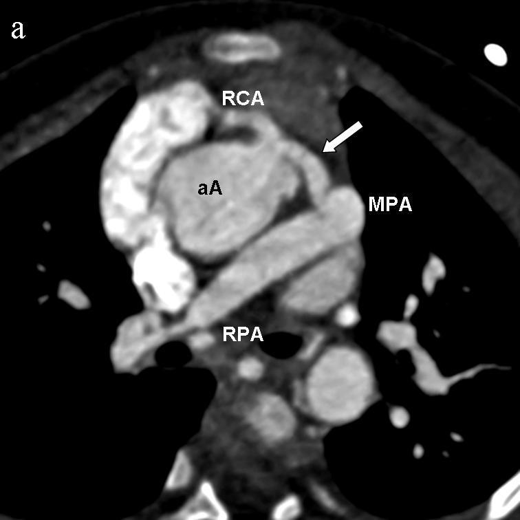 Pulmonary atresia with coronary artery