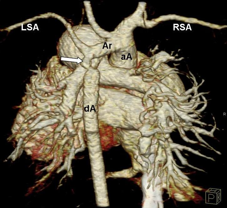 (a) MPR image shows simultaneously the ASD and muscular