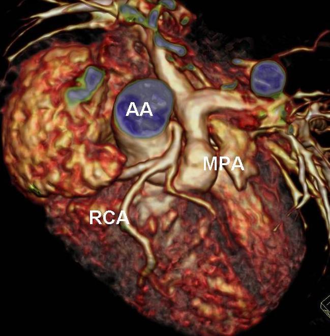 Tetralogy of Fallot with coronary artery anomaly 80 Kv/80 mas