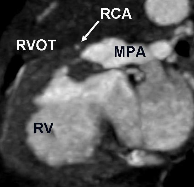 43mSv) MIP reformatted image shows critical stenosis of the