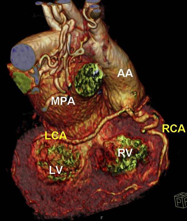 Transposition of great arteries with single coronary artery