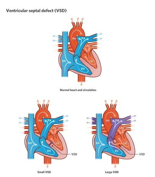 7) Cardiovascular Developmental Abnormalities Ventricular