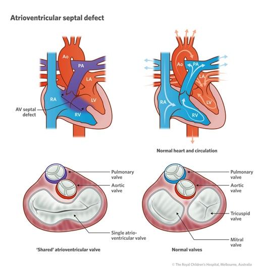 7) Cardiovascular Developmental Abnormalities Atrioventricular Septal Defect (AVSD) - Common in babies with Down syndrome.