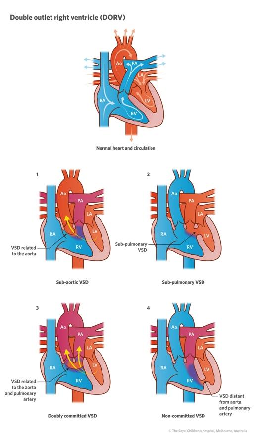 7) Cardiovascular Developmental Abnormalities Double Outlet Right Ventricle (DORV) - 0.
