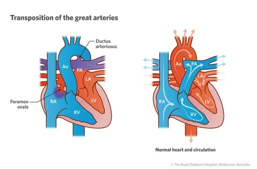 7) Cardiovascular Developmental Abnormalities Transposition of the Great Arteries (TGA) - 0.28-0.