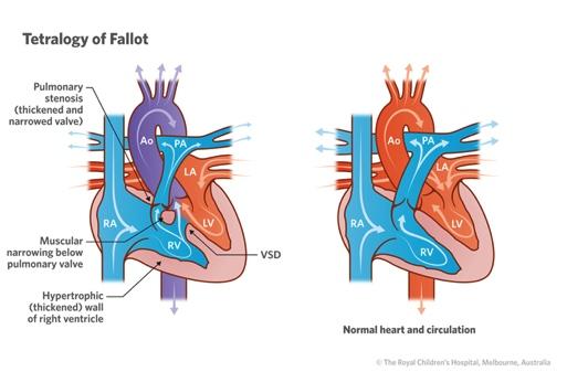 7) Cardiovascular Developmental Abnormalities Tetralogy of Fallot - 0.