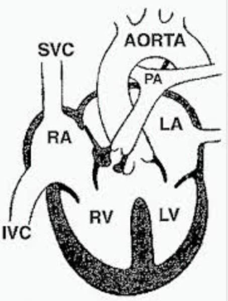 Tetralogy of Fallot (TOF) Malalignment VSD Overriding aorta RV