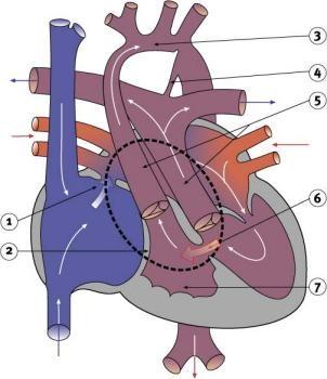 Hypoplastic Left Heart Characterized by hypoplasia (underdevelopment or absence) of the left ventricle obstructive