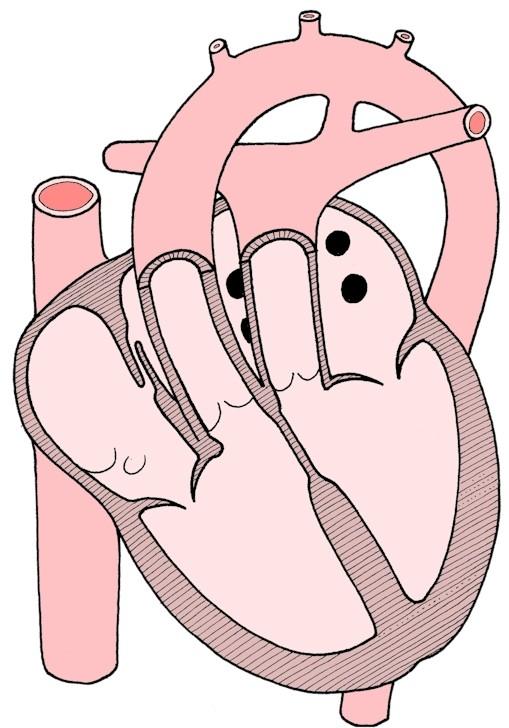 transposition of the great vessels - the aorta exits from the right ventricle, and the pulmonary trunk exits from the left ventricle.