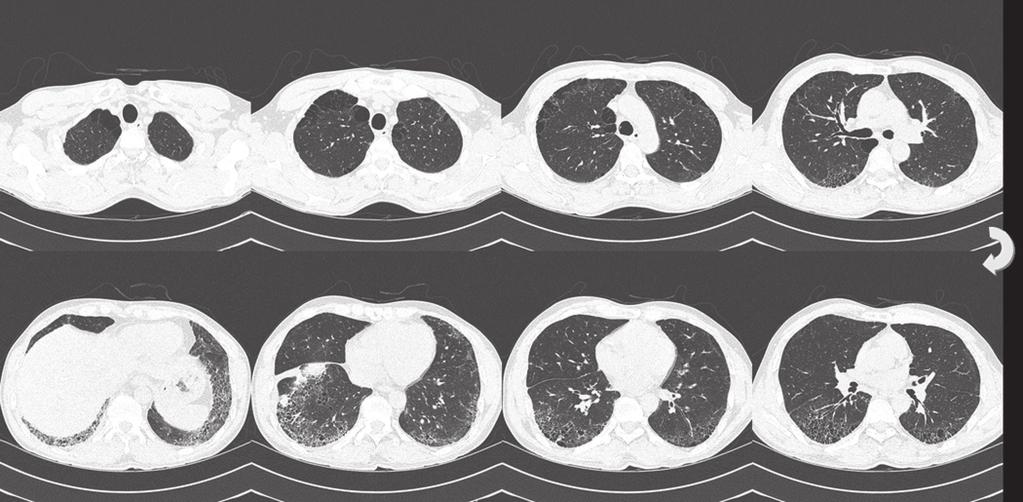 Park et al. A B C Fig. 3. 47-year-old man who had pathologically proven nonspecific interstitial pneumonia. A. CT images predominantly showed basal and peripheral reticular opacities.