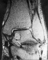 Fig. 3 MRI appearance of the intraosseous lipoma in the talus.
