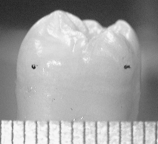 C Treatment point Fig. 1. Tooth sample and treatment spot. Modulated laser light generated infrared blackbody radiation from teeth upon absorption and nonradiative energy conversion.