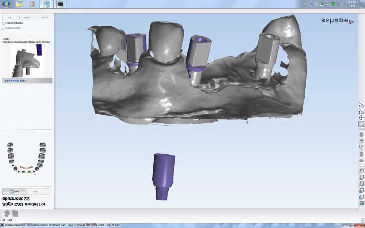 4 The scanning abutments installed on the model define the position