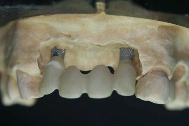 15 The complete Zirconium abutment sits completely passively after a correctly executed CAD design, milling and sintering.