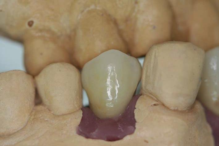 The screw-retained Zirconium crown. 20 The completed work ready to be shipped to the clinic.