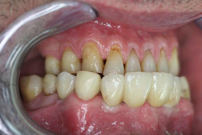 Zirconiumabutment bridges and crowns can be cleaned very well, which is a critical factor in the retention