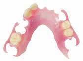 quick and easy to fit less bulky than acrylic dentures good for small to medium sized