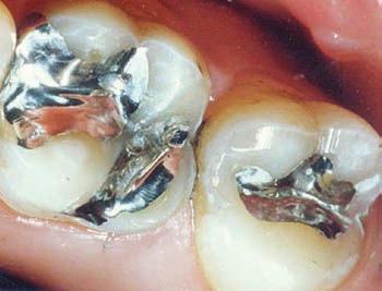 Amalgam Amalgam is the least expensive material for filling a cavity. It is also very strong and durable.