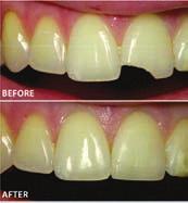 Composite Resin Composite resins comprise most of the white or tooth coloured fillings and are, essentially, plastic.