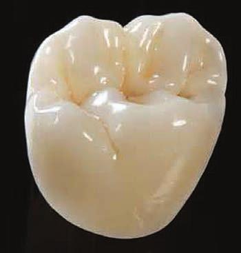 Zirconium Crowns Zirconium crowns and bridges are so strong they can be used anywhere in the mouth.