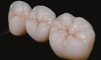 It is considered a good option for damaged, stained or poor quality teeth. What is an E-Max crown?