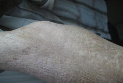 Figure 1: Skin in the patient affected by the REBD.