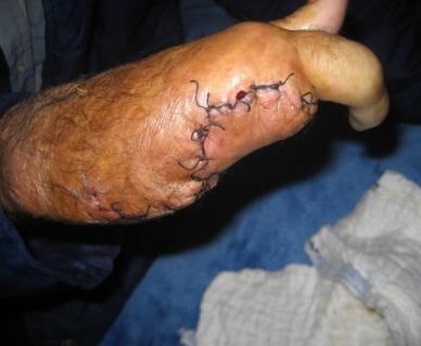 Wide local excision with ray amputation of the 3 ulnar fingers was performed, with preservation