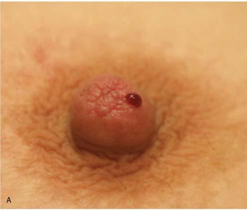 Clinical Presentation Nipple Discharge - Spontaneous or Non-spontaneous - Color of discharge -