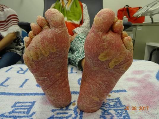 PSORIATRIC ARTHRITIS Foot involvement Foot involvement is common in PsA, including dystrophic nails, toe