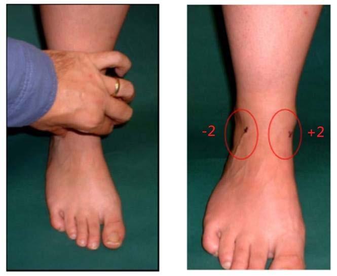 FOOT POSTURE INDEX 1. Talar head palpation 2. Supra & infra lateral malleolar curvature 3. Inversion/eversion of calcaneus 4. Bulging in talonacvicular joint 5.