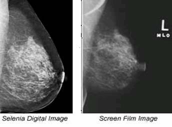 Key Drivers in Mammography Conversion to digital More than 5x cost of film-based Improves