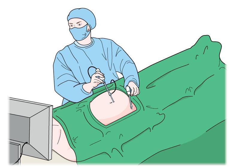 Keyhole surgery (laparoscopic) In this type of surgery, small openings are made in the body instead of one large cut.