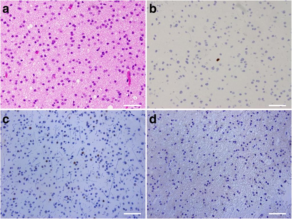 Inoue et al. World Journal of Surgical Oncology (2016) 14:152 Page 3 of 6 Fig. 2 Photomicrographs showing histopathology of the left insular tumor.
