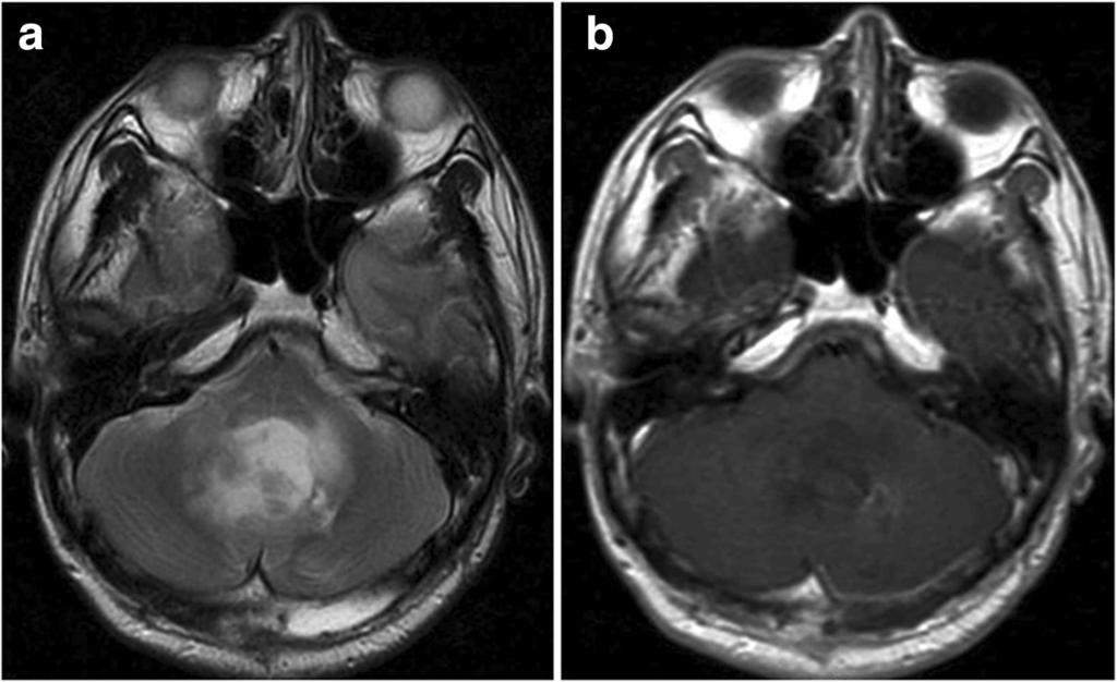 The tumor was enhanced in a ring-like fashion by Gd and accompanied by marked peritumoral brain edema. Axial T2-weighted (a), T1-weighted (b), and Gd-enhanced T1-weighted (c) MR images.