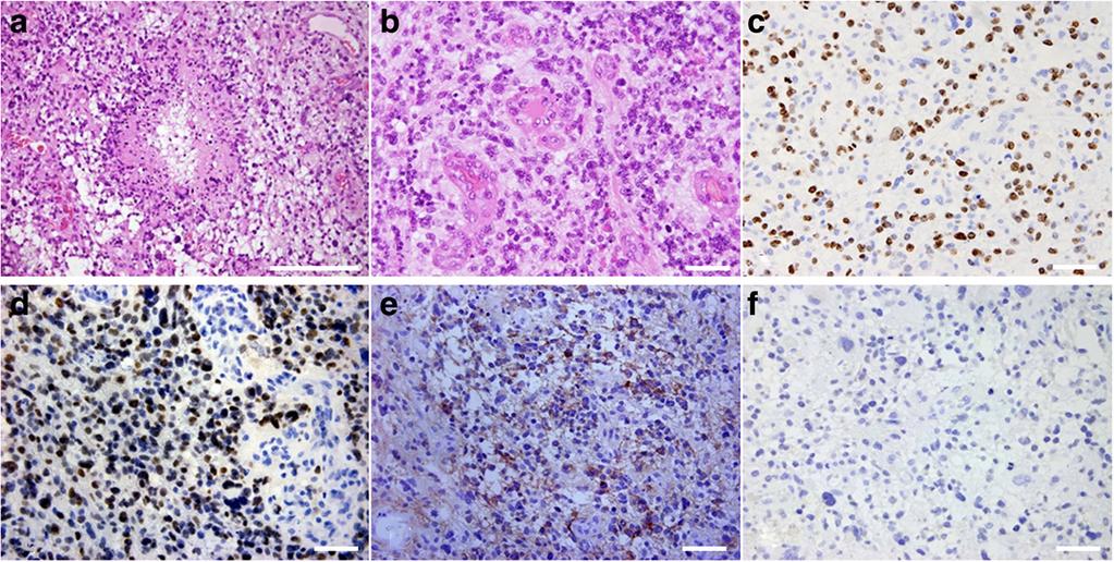 Inoue et al. World Journal of Surgical Oncology (2016) 14:152 Page 5 of 6 Fig. 6 Photomicrographs showing histopathology of the cerebellar tumor.