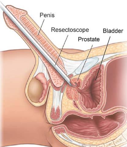 It is done to treat urinary symptoms caused by an enlarged prostate gland (benign prostatic hyperplasia, or BPH). The goal of a TURP is to make it easier for you to pee (urinate).