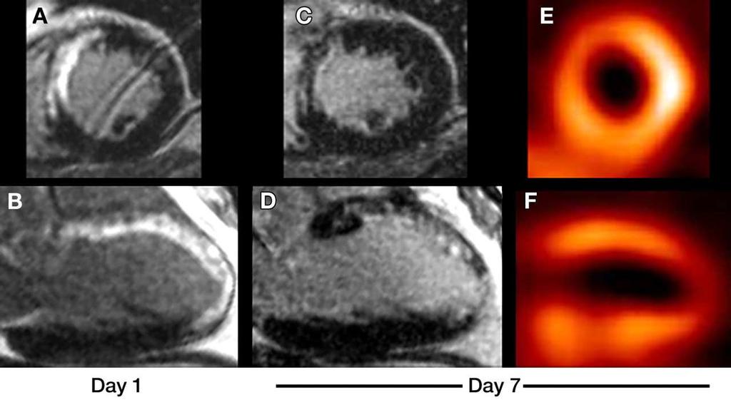 Acute myocardial infarction: cardiac MR shows a decrease in delayed enhancement during the 1st week after reperfusion 17 patients with successfully
