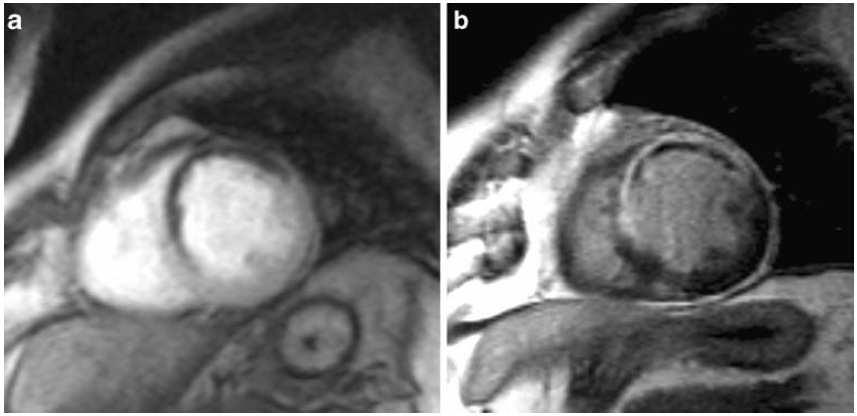 Prognostic impact of Persistent Microvascular Obstruction (PMO) as assessed by contrast-enhanced CMR in reperfused AMI Methods: 184 patients within the week after successfully reperfused first AMI