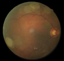 vitreopathy and pucker Fundus Dilated