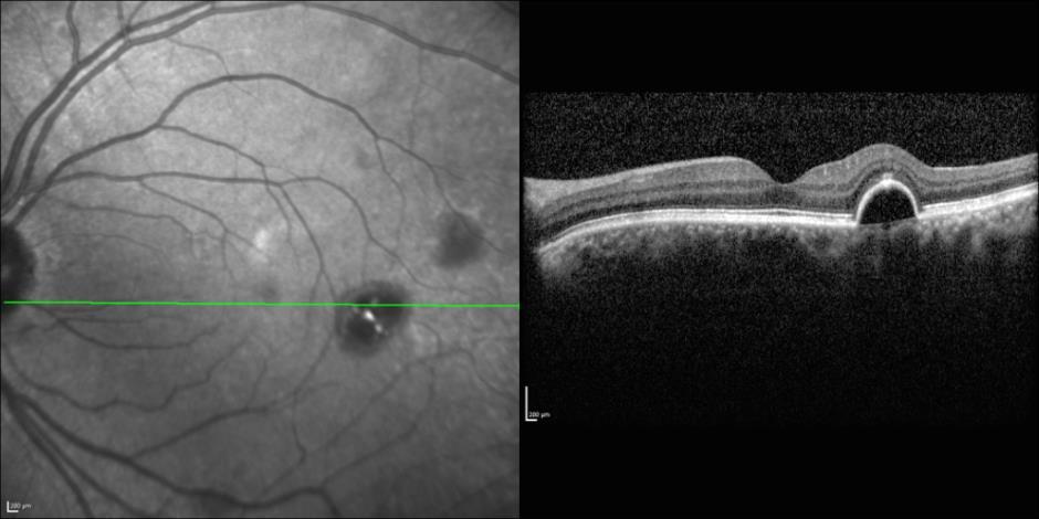 Patient AB Born in 1961 PED Autofluorescence Dilated 45 EasyScan Zero-dilation IR