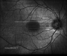 retinal thickness map 3D segmentation of RPE