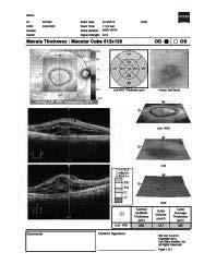 Macular hole sizes Small <= 250 microns