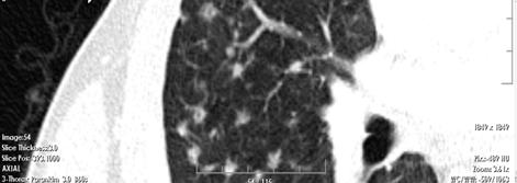 Chest CT imge from 27-yer-old smoker mle with iopsy-proven Pulmonry