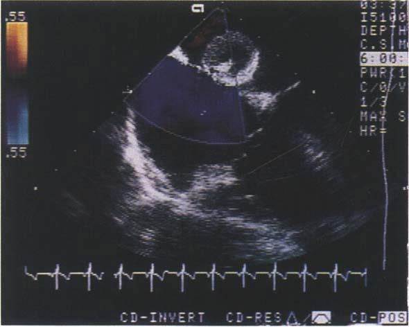 ECHOCARDIOGRAPHY IN ASD CLOSURE Figure 2. Four-chamber view from the same patient demonstrating balloon sizing of the atrial septal defect under transesophageal echo guidance.