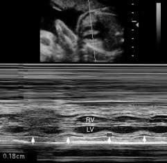 Pericardial fluid was identified by two-dimensional ultrasound in 14 fetuses (52%).