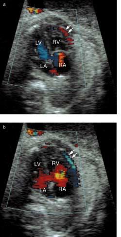 velocities in normal fetuses and suggested that tissue Doppler imaging can be utilized for quantitative evaluation of systolic and diastolic function of the ventricles as in postnatal