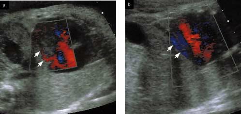 Figure 3 Color Doppler echocardiograms in systolic (a) and diastolic (b) phases from a fetus with pulmonary atresia and intact ventricular septum.