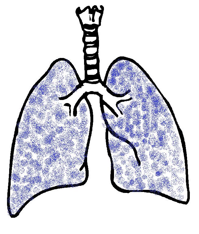 Monitoring a Lung Fluid Content. Evolution of Pulmonary Edema (PED) LI Dry lungs - Insignificant amount of fluid in lungs LI Congested lungs Increased amount of fluid accumulation in lungs 1.