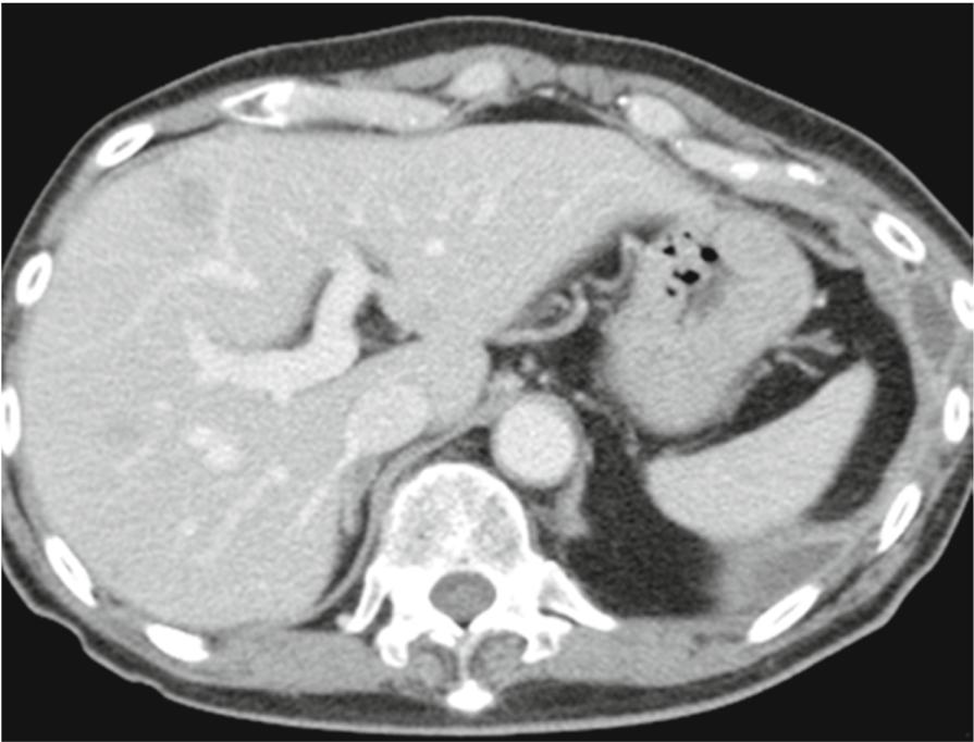 This ws confirmed y enhnced computed tomogrphy (CT) scn, which showed 40 mm tumor in the left lower loe with left pleurl effusion. Enhnced CT scn of the domen reveled liver nd drenl metstses.
